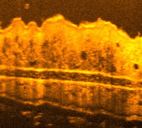 Optical Coherence Tomography